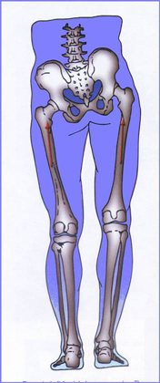 Leg Length Deficiency